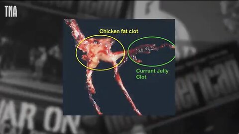 Richard Hirschman - Fibrous Clots in Dead Are NOT Normal