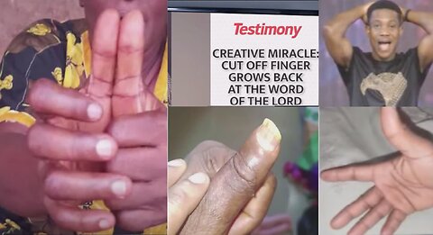 CREATIVE MIRACLE || CUT OFF FINGER GROWS BACK AND CHOPPED OFF THUMBS REGROWS AT THE WORD OF THE LORD