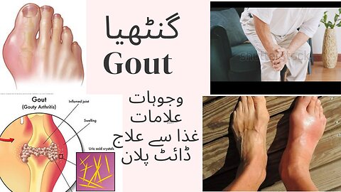 What is Gout. Diet plan for gout.Causes, symptoms,risk factors and dietary guidelines about gout.