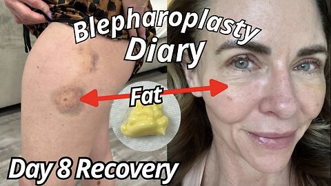 28cc of Fat Grafted: Eyelid Lift Surgery Day 8 Recovery