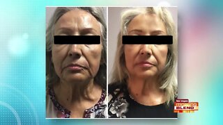 Non-Surgical Face Lift