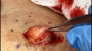 Removal of an Epidermal Cyst on the upper back/neck