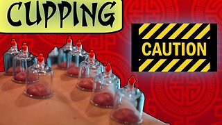 Cupping - Warning! - The Other Acupuncture...