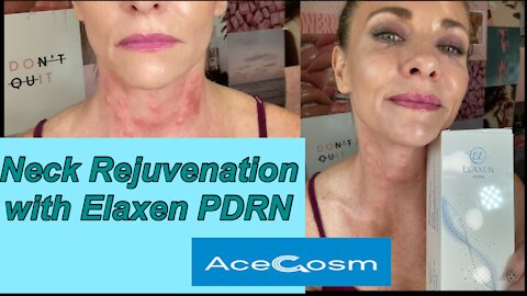 How I Rejuvenate My Neck | Elaxen PDRN | AceCosm