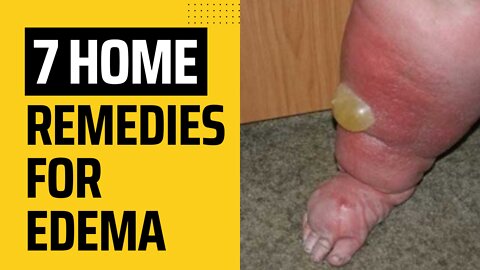 7 Home Remedies For Edema In Feet And Ankles