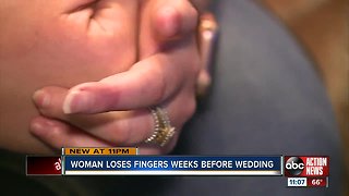 Manatee County doctor saves bride's fingers after log splitter accident