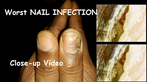 Worst Nail Infection Video ever. Close-up will make you ewww