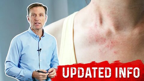 Keto Rash is a Bile Deficiency – Bile Salts, Dietary Fats, and Keto Rash – Dr. Berg