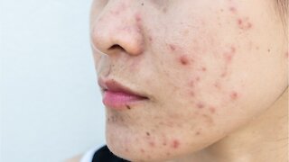 What Causes Acne? (1)
