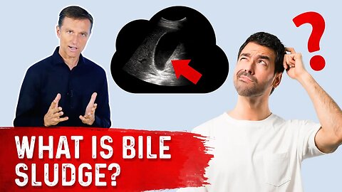 Bile Sludge is a Pre-Gallstone Condition!! – Bile Sludge Treatment Covered by Dr. Berg