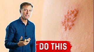 How to Deal With Ringworm Naturally