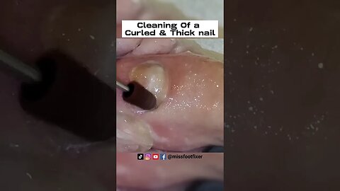 Cleaning Of a Curled & Thick nail 2023👣 Amazing Pedicure Transformation👣 BY MISS FOOT FIXER