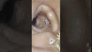 Tiny Creepy Crawler Emerges Out Of A Woman’s Ear