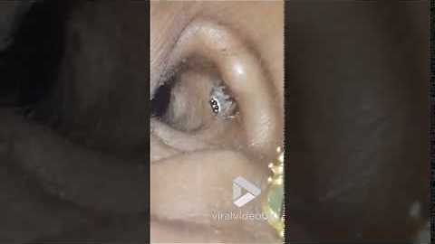Tiny Creepy Crawler Emerges Out Of A Woman’s Ear