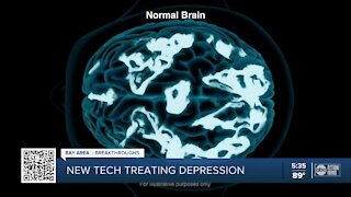 Depression sufferers who can't take medication can use new technology that improves symptoms