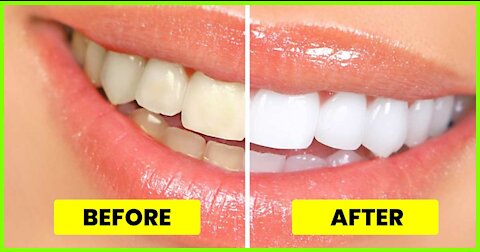 HOW TO WHITEN TEETH IN 3 MINUTES AT HOME, GET RID OF YELLOW TEETH