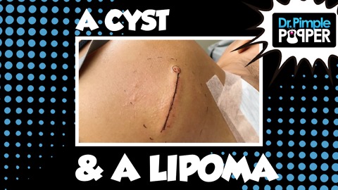 When a Cyst and Lipoma make Friends