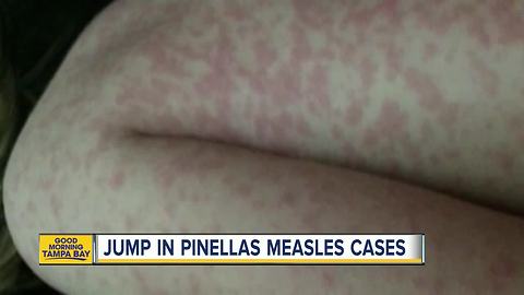 4 more cases of measles reported in Pinellas Co.