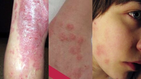 9 Foods To Avoid With Eczema
