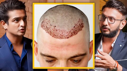 Affordable Hair Transplant In India - Cost, Side Effects & Precautions Explained By Top Dermat