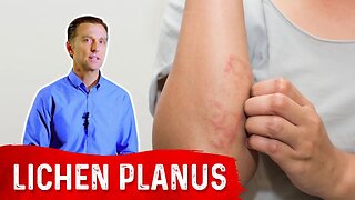 Lichen Planus: Best Remedy