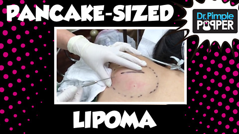 Part 1- A Pancake-Sized Lipoma on the Back with Dr Pimple Popper