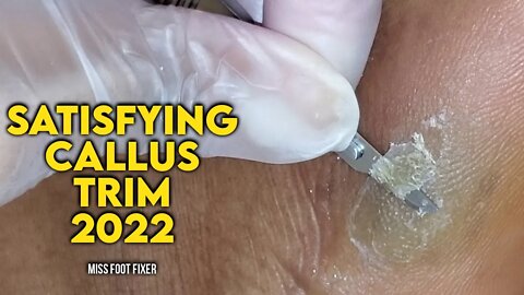 SATISFYING CALLUS TRIM FROM SIDE OF FEET 2022 BY FOOT SPECIALIST MISS FOOT FIXER