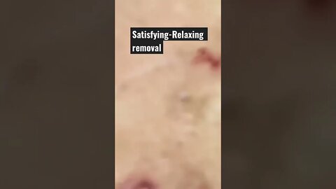 Satisfying Relaxing Blackhead Removal Part 1 #shorts #satisfying #removal #pimplepopping #pimple