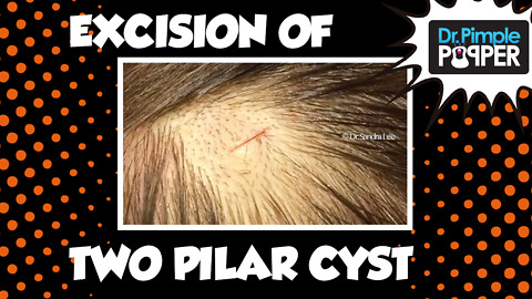 Two GREAT pilar cysts excised by Dr Rebish!