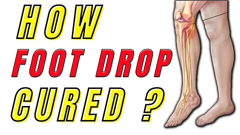 Can foot drop be cured without surgery