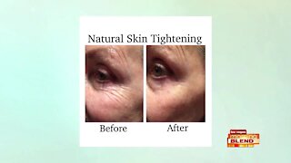 Ultrasound Skin Lift