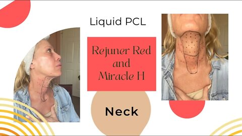 Liquid Neck Lift - Miracle H and Rejuner PCL