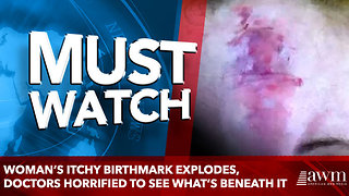 Woman’s Itchy Birthmark Explodes, Doctors Horrified To See What’s Beneath It