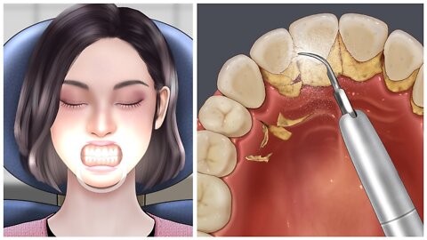 [ASMR] 누렇고 딱딱한 치석 제거 _ tartar removal animation _ teeth scaling