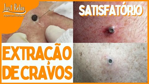 Satisfatório Remoção de Cravos - Vídeos Satisfatórios Asmr - Just Relax | Apenas Relaxe