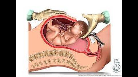 A cesarean section _ known as a C-section _ is a surgery to deliver a baby via the abdomen