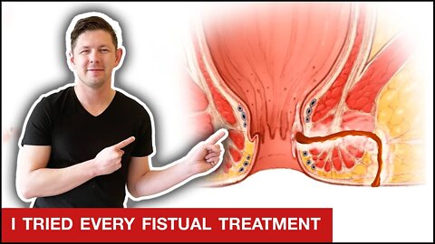 How To Heal A Peri-Anal Fistula