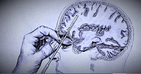 The Dark side of Science: The Lobotomy, the worst surgery in history? (Documentary)