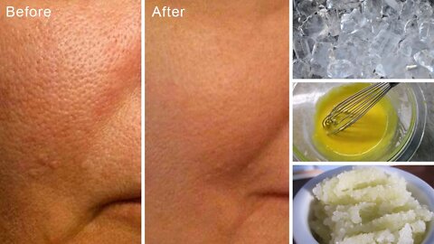 Home Remedies for Open and Large Pores