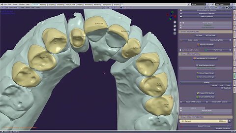 Crowns, Veneers and Onlays