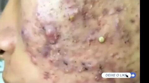 Vídeo SATISTATÓRIO para remoção de cravos e espinhas no rosto Blackhead