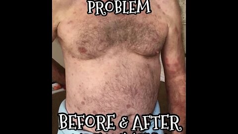 Sean's Undiagnosed Skin Condition, treated medicinally(18 months). We used Herbs&Healing to help it.