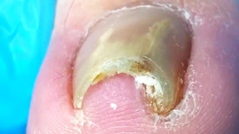 Extremely curly ingrown nails, perfectly trimmed~