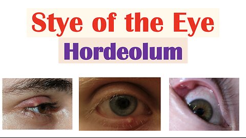 Eye Stye (Hordeolum) | Causes, Symptoms, Diagnosis & At Home Treatments