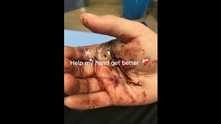 I drilled a whole in my hand 🤚 help by subscribeing to me🥹