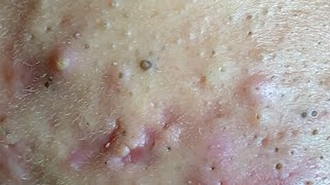 Make your Acne Treatment Blackheads removal