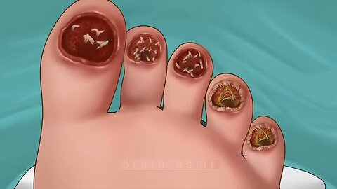 ASMR Maggot infested and fungal infection toenail removal | @SatisfyingASMRanimations
