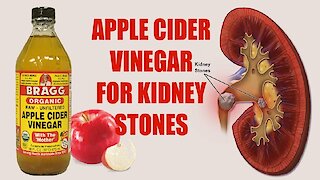 How To Use Apple Cider Vinegar To Dissolve Kidney Stones