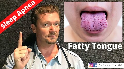 1 Cause of SLEEP APNEA You’ve Never Heard of? (Fatty Tongue) 2021