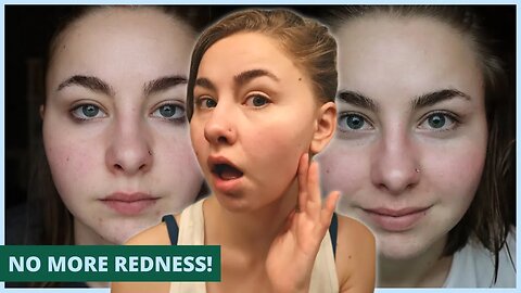 Y'OUR SKINCARE REVIEW | No More Redness & Reduced Scarring